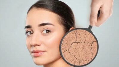 Yaz aylarında yapılan cilt bakım uygulamaları ne kadar güvenli? Fraksiyonel
